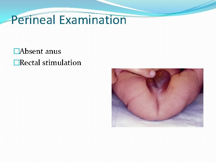 Perineal Examination �Absent anus �Rectal stimulation 