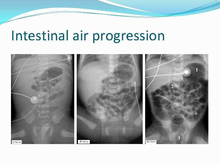Intestinal air progression 