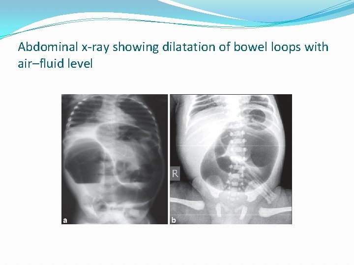 Abdominal x-ray showing dilatation of bowel loops with air–fluid level 