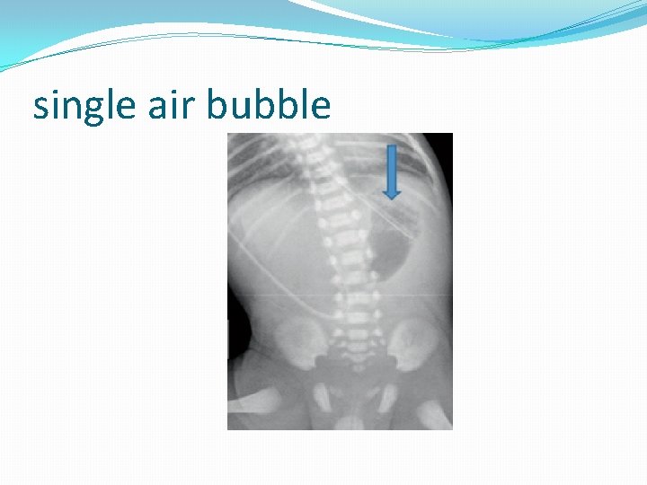 single air bubble 