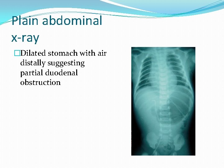 Plain abdominal x-ray �Dilated stomach with air distally suggesting partial duodenal obstruction 