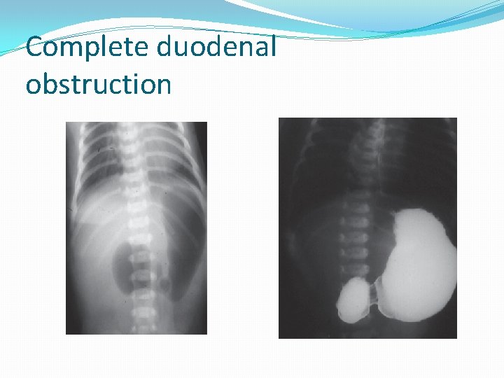 Complete duodenal obstruction 