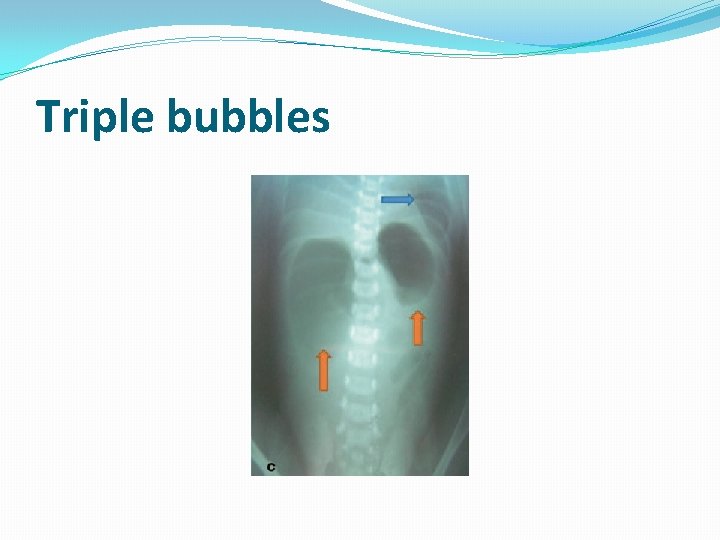 Triple bubbles 