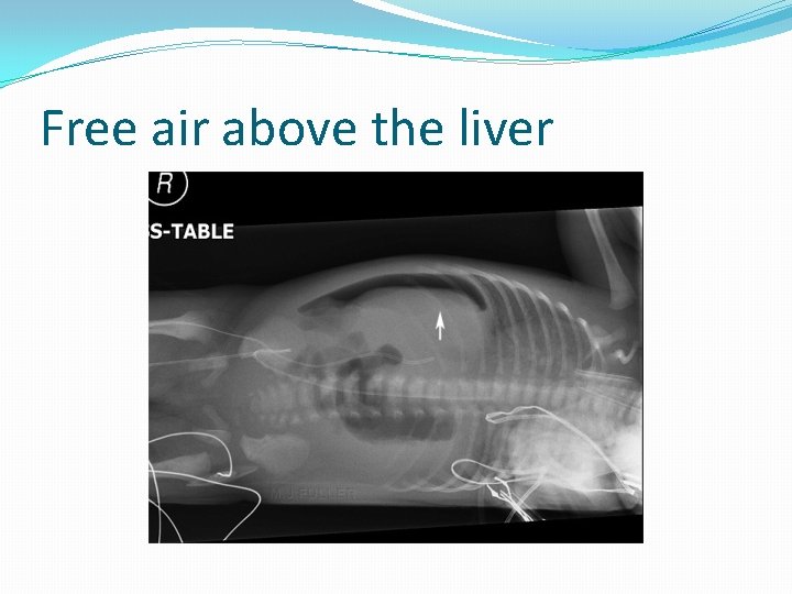 Free air above the liver 