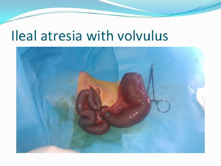 Ileal atresia with volvulus 