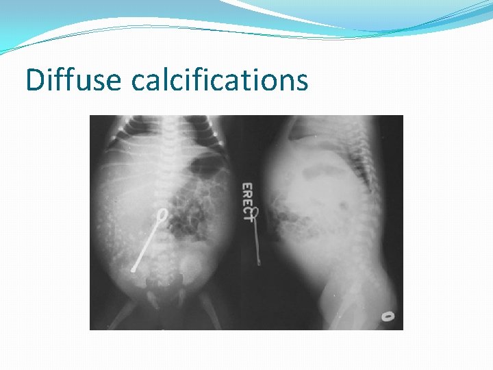 Diffuse calcifications 
