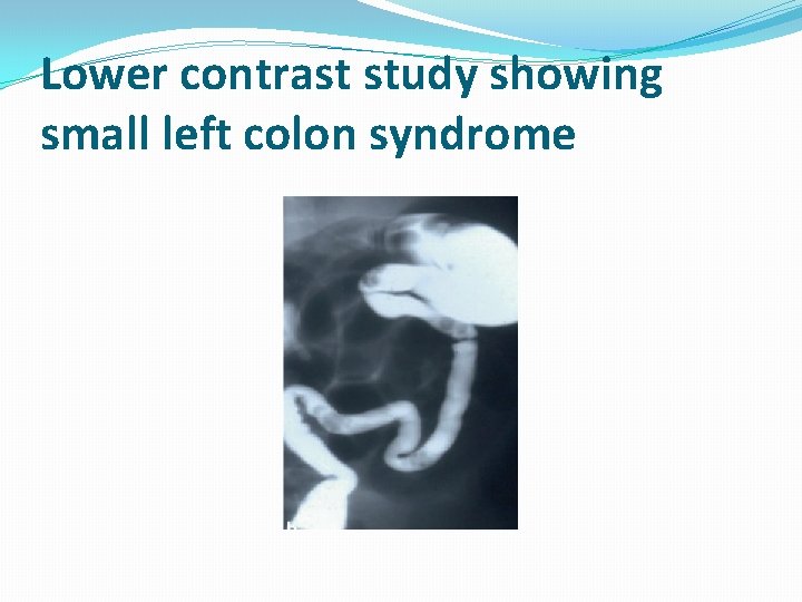 Lower contrast study showing small left colon syndrome 