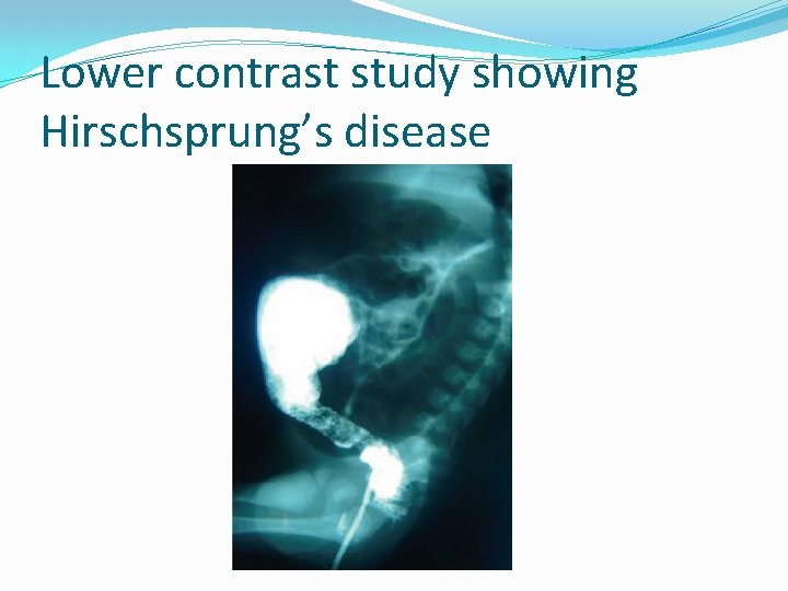Lower contrast study showing Hirschsprung’s disease 