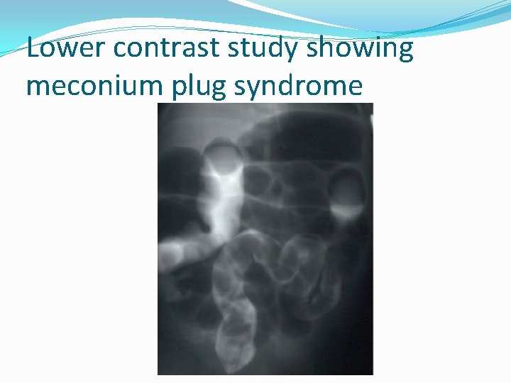 Lower contrast study showing meconium plug syndrome 
