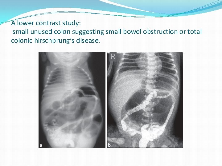 A lower contrast study: small unused colon suggesting small bowel obstruction or total colonic