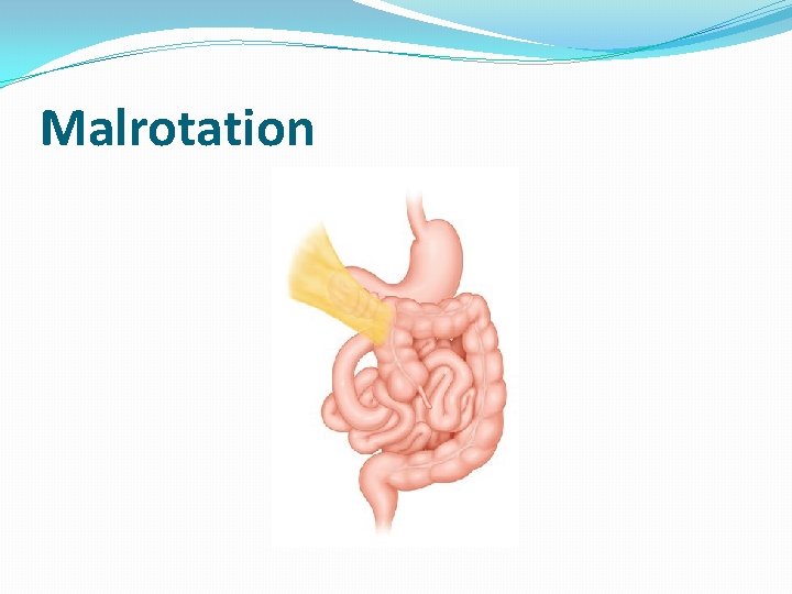 Malrotation 