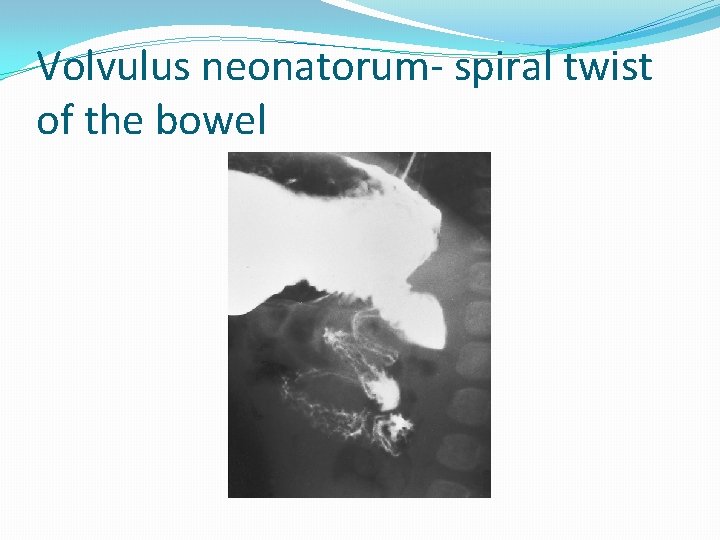 Volvulus neonatorum- spiral twist of the bowel 