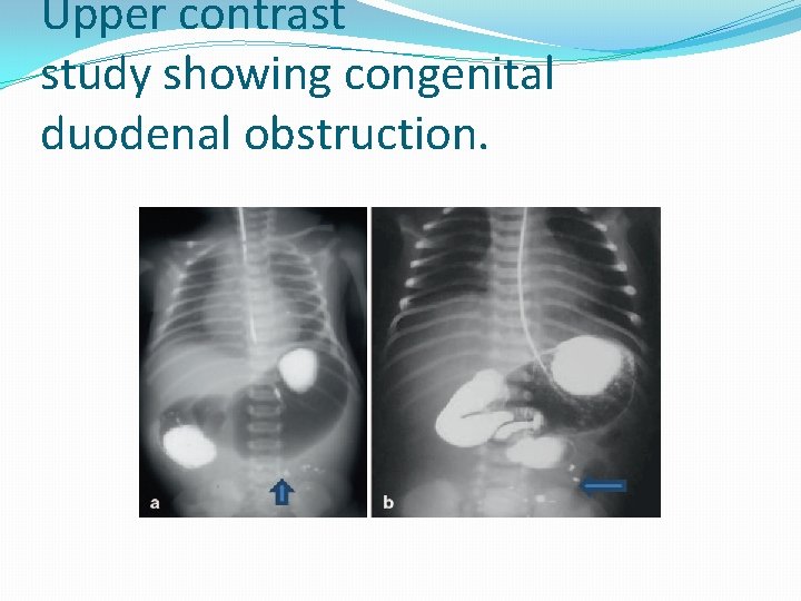 Upper contrast study showing congenital duodenal obstruction. 