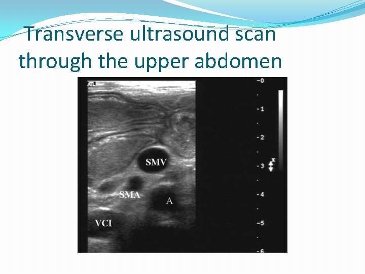 Transverse ultrasound scan through the upper abdomen 