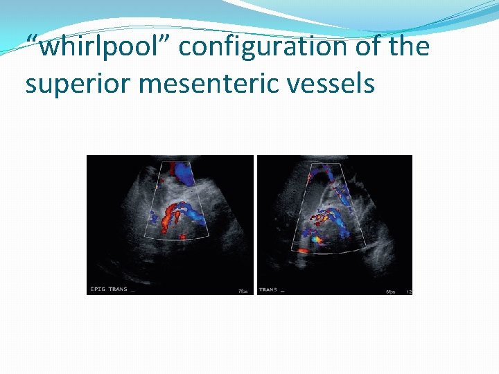 “whirlpool” configuration of the superior mesenteric vessels 