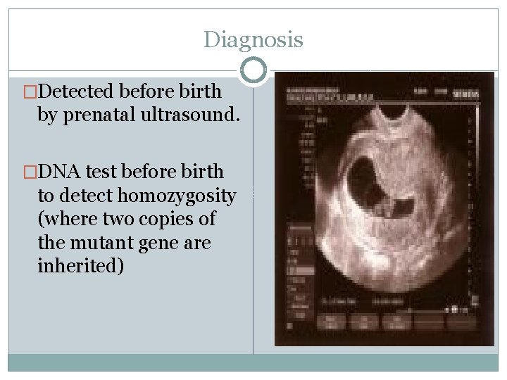 Diagnosis �Detected before birth by prenatal ultrasound. �DNA test before birth to detect homozygosity