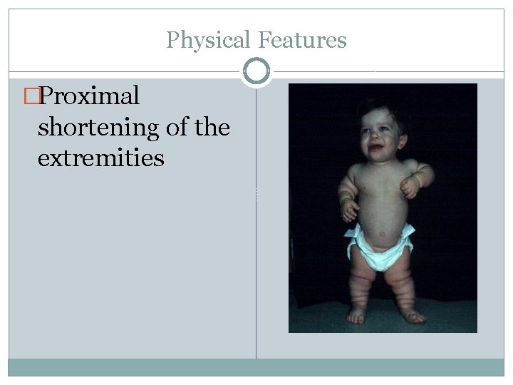 Physical Features �Proximal shortening of the extremities 