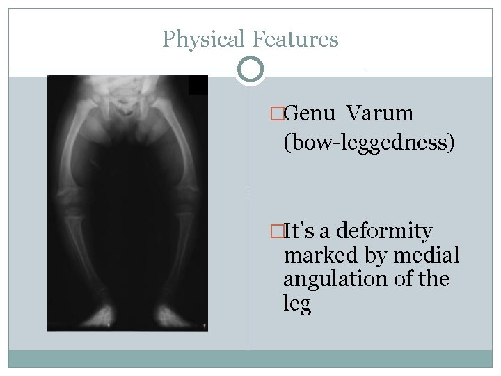 Physical Features �Genu Varum (bow-leggedness) �It’s a deformity marked by medial angulation of the