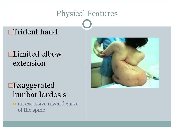 Physical Features �Trident hand �Limited elbow extension �Exaggerated lumbar lordosis an excessive inward curve