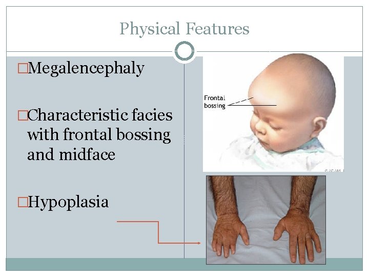 Physical Features �Megalencephaly �Characteristic facies with frontal bossing and midface �Hypoplasia 
