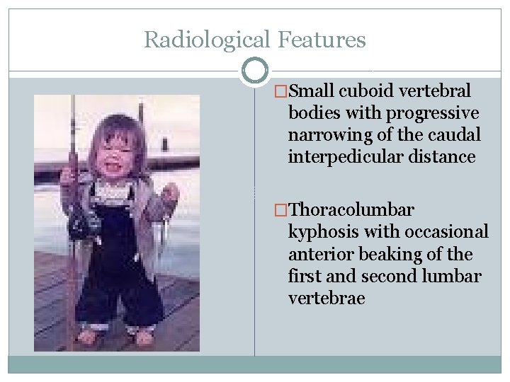 Radiological Features �Small cuboid vertebral bodies with progressive narrowing of the caudal interpedicular distance