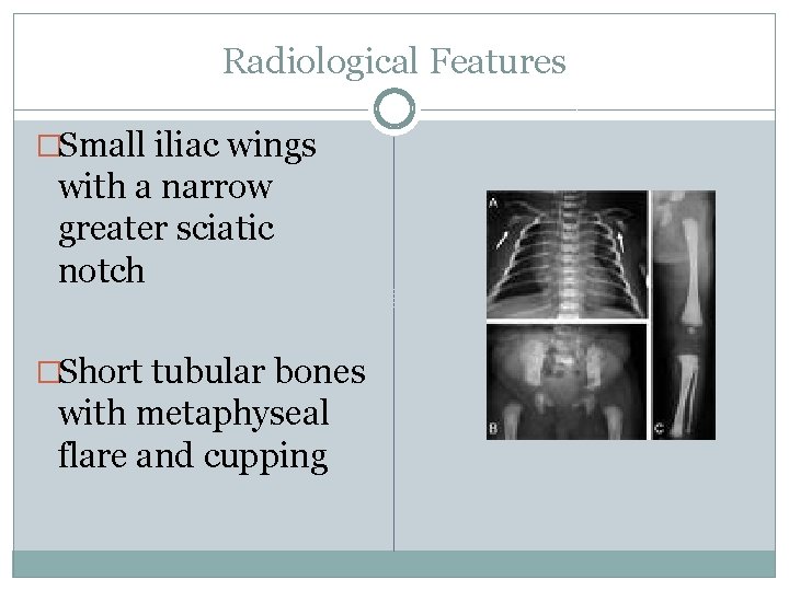 Radiological Features �Small iliac wings with a narrow greater sciatic notch �Short tubular bones