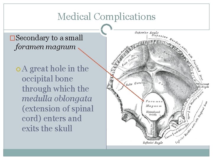 Medical Complications �Secondary to a small foramen magnum A great hole in the occipital
