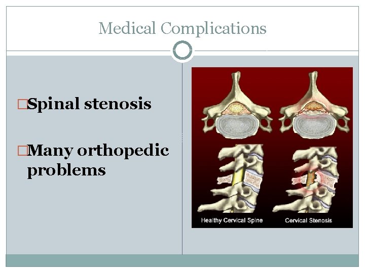 Medical Complications �Spinal stenosis �Many orthopedic problems 