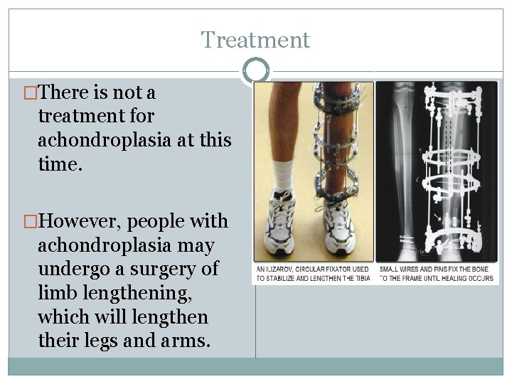 Treatment �There is not a treatment for achondroplasia at this time. �However, people with