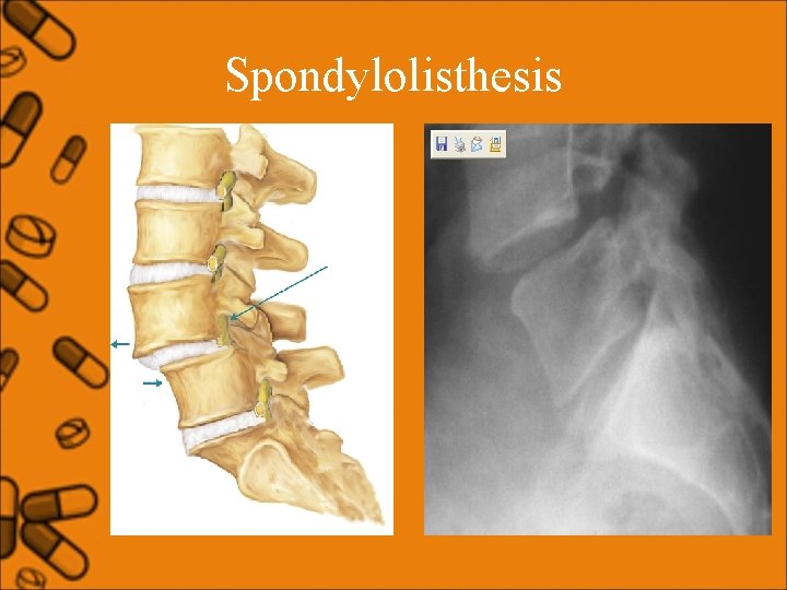 Spondylolisthesis 