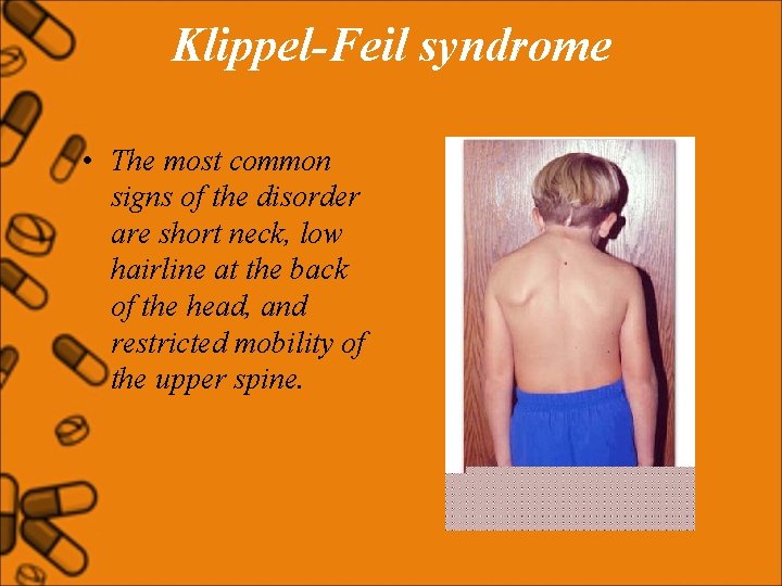 Klippel-Feil syndrome • The most common signs of the disorder are short neck, low