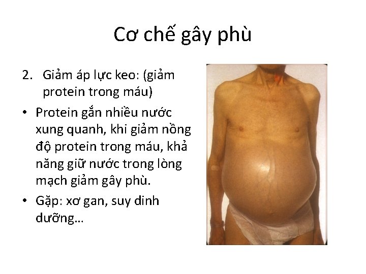 Cơ chế gây phù 2. Giảm áp lực keo: (giảm protein trong máu) •