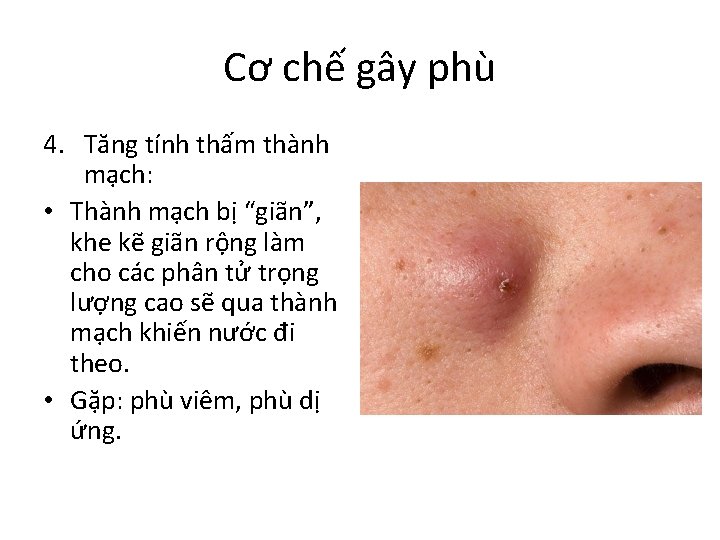 Cơ chế gây phù 4. Tăng tính thấm thành mạch: • Thành mạch bị