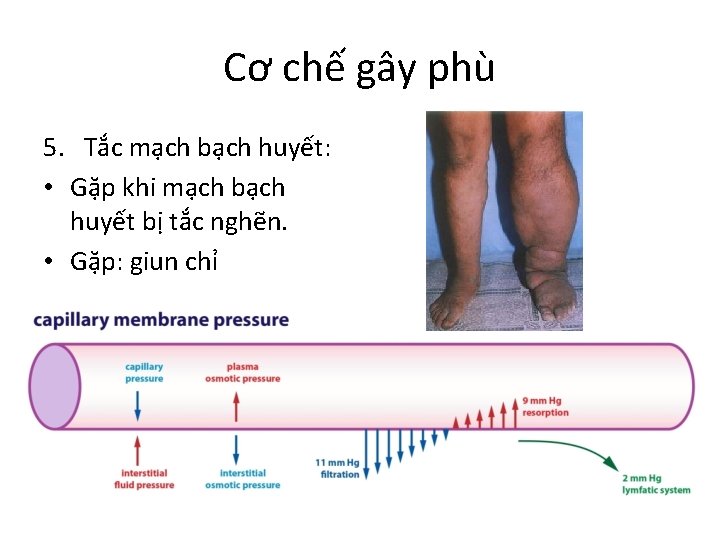 Cơ chế gây phù 5. Tắc mạch bạch huyết: • Gặp khi mạch bạch