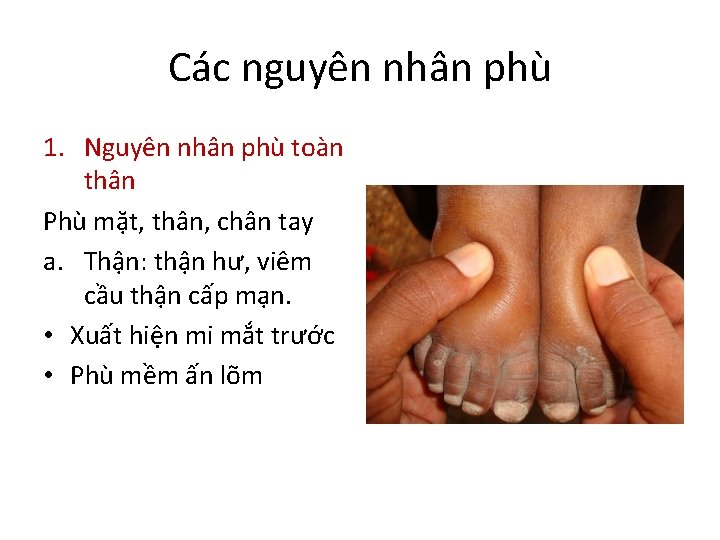 Các nguyên nhân phù 1. Nguyên nhân phù toàn thân Phù mặt, thân, chân