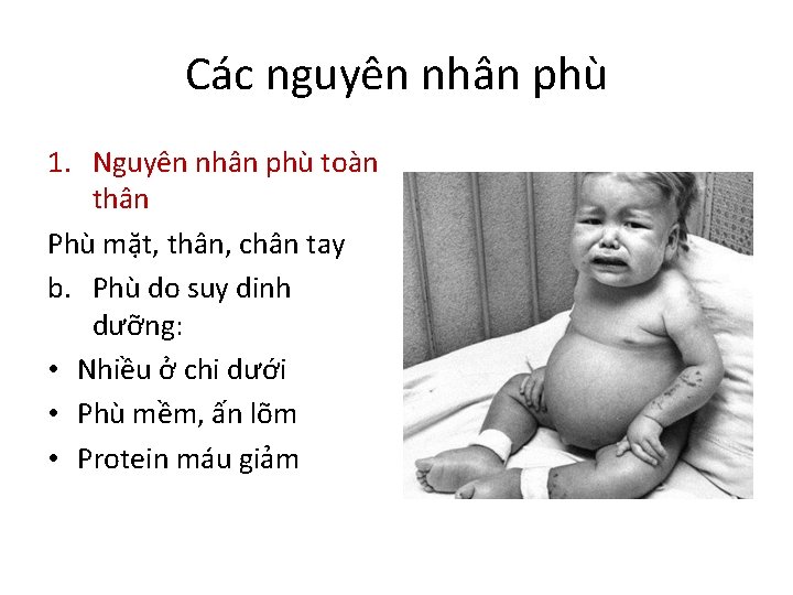 Các nguyên nhân phù 1. Nguyên nhân phù toàn thân Phù mặt, thân, chân