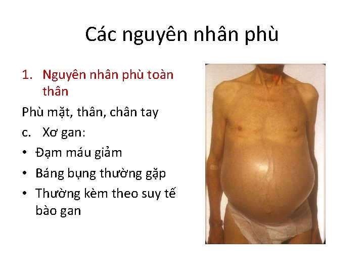 Các nguyên nhân phù 1. Nguyên nhân phù toàn thân Phù mặt, thân, chân