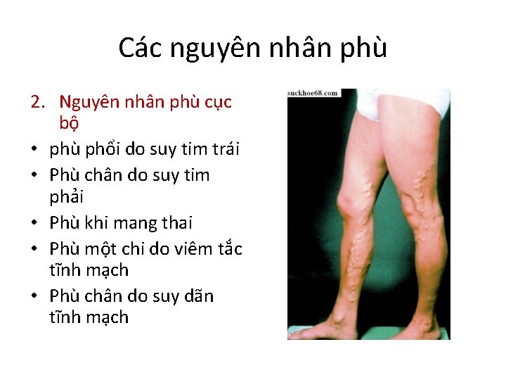 Các nguyên nhân phù 2. Nguyên nhân phù cục bộ • phù phổi do