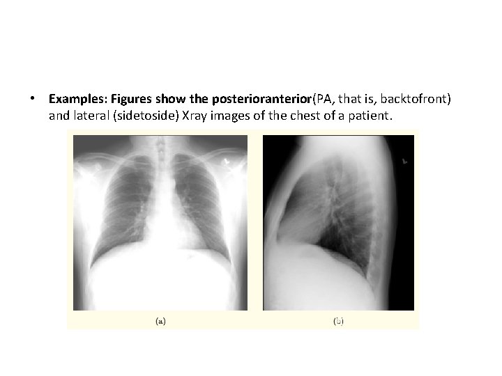  • Examples: Figures show the posterioranterior(PA, that is, backtofront) and lateral (sidetoside) Xray