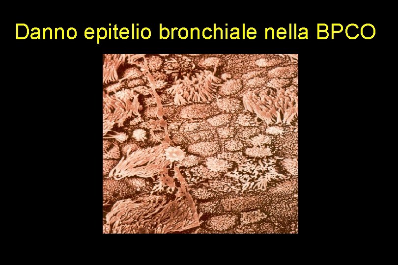 Danno epitelio bronchiale nella BPCO 