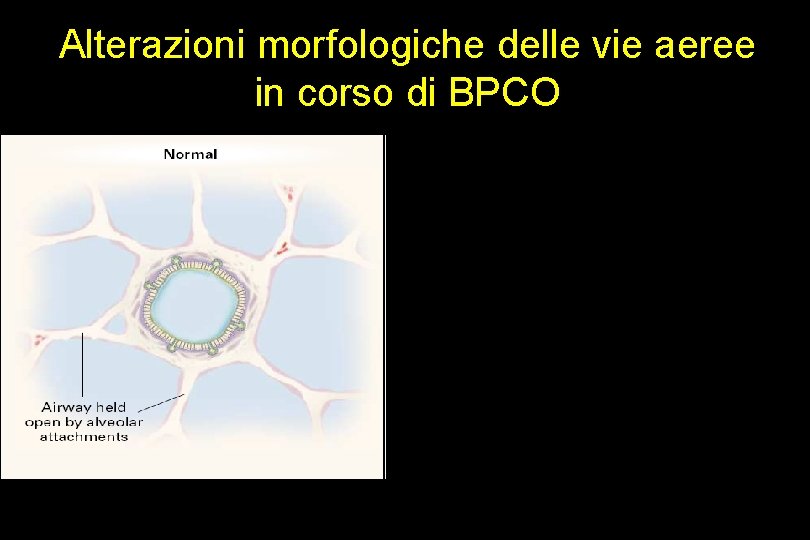 Alterazioni morfologiche delle vie aeree in corso di BPCO 