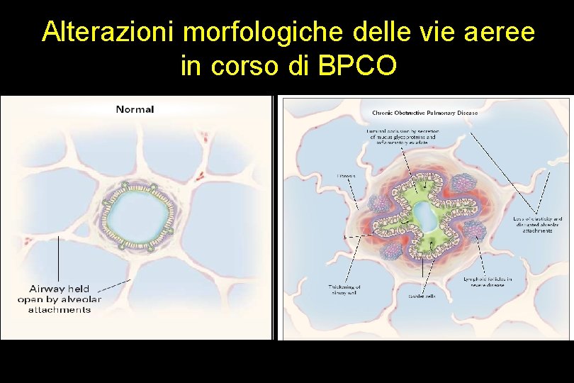 Alterazioni morfologiche delle vie aeree in corso di BPCO 