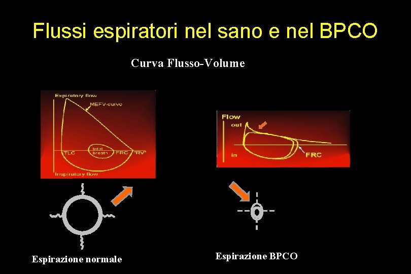 Flussi espiratori nel sano e nel BPCO Curva Flusso-Volume Espirazione normale Espirazione BPCO 