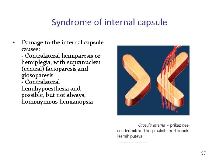 Syndrome of internal capsule • Damage to the internal capsule causes: - Contralateral hemiparesis