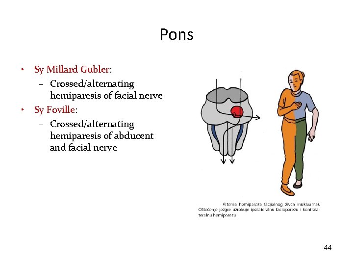 Pons • • Sy Millard Gubler: – Crossed/alternating hemiparesis of facial nerve Sy Foville: