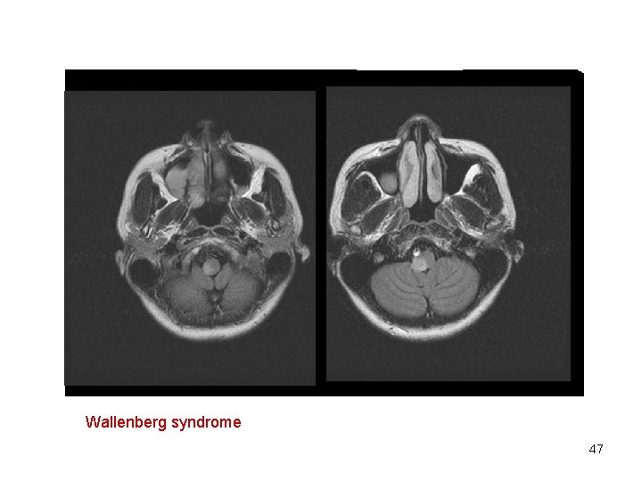 Wallenberg syndrome 47 