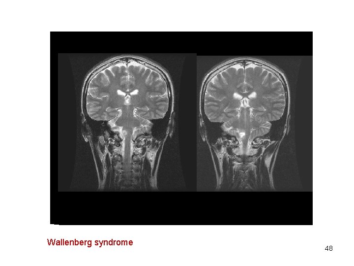 Wallenberg syndrome 48 