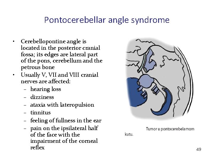 Pontocerebellar angle syndrome • • Cerebellopontine angle is located in the posterior cranial fossa;