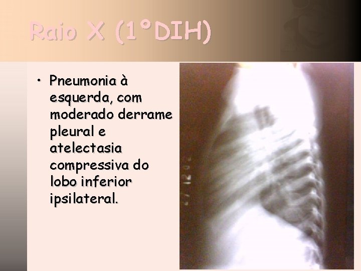 Raio X (1ºDIH) • Pneumonia à esquerda, com moderado derrame pleural e atelectasia compressiva