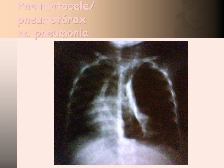 Pneumatocele/ pneumotórax na pneumonia 